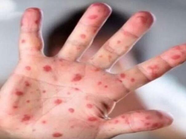 Na području Kantona Sarajevo proglašena epidemija morbila