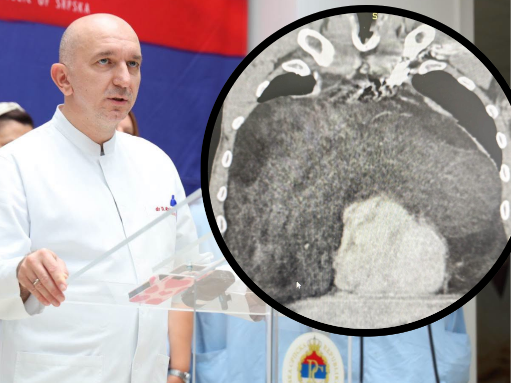 Na UKC-u RS odstranili tumor teži od šest kilograma