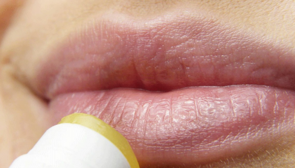 Naučnici otkrili: Zašto se herpes uvijek vraća?