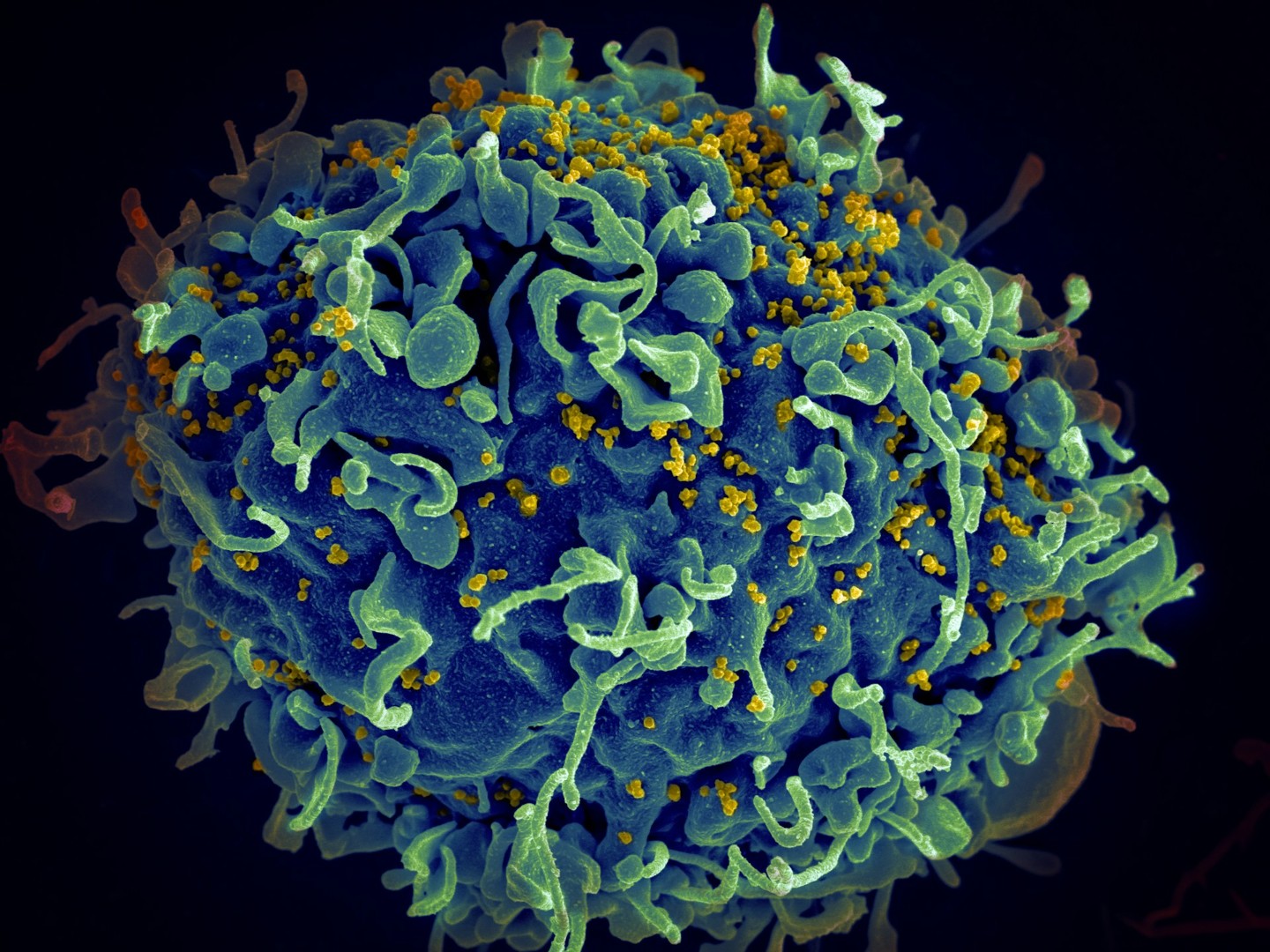 Naučnici uspješno uklonili HIV iz zaraženih ćelija