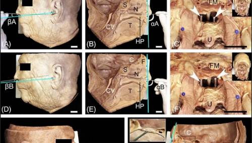 Nema povrede mozga prilikom uzimanja brisa na koronavirus