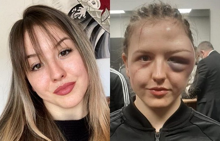 Njemačka bokserka pokazala deformisano lice nakon borbe u kojoj je slavila