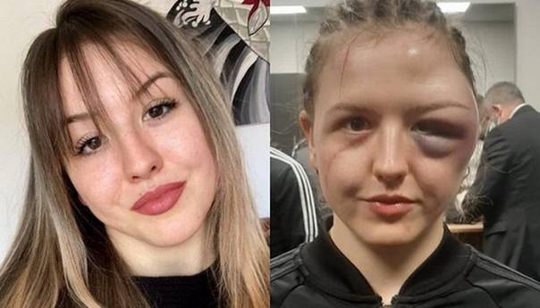 Njemačka bokserka pokazala deformisano lice nakon borbe u kojoj je slavila