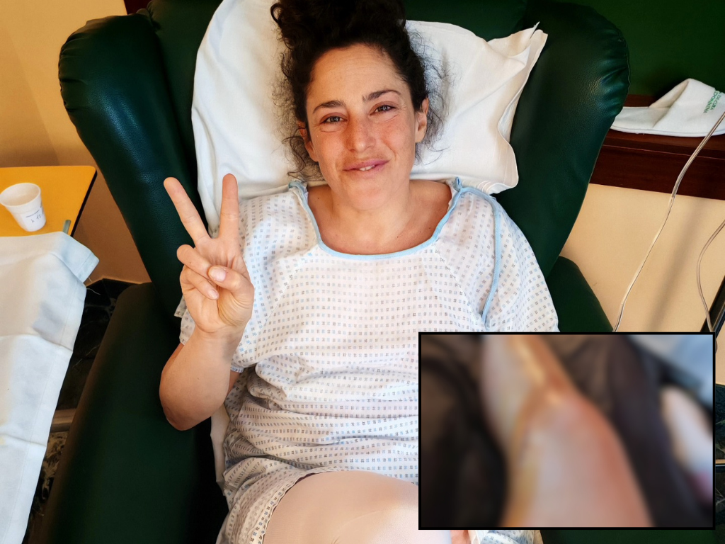 Noga Federice Brignone izgleda stravično nakon operacije
