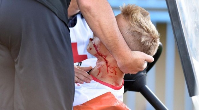 Nogometašu u Hrvatskoj pukla vilica na utakmici