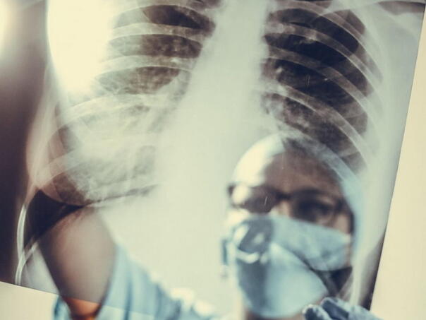 Nova nada za oboljele od hroničnih plućnih bolesti – transplantacija vlastitih plućnih stanica
