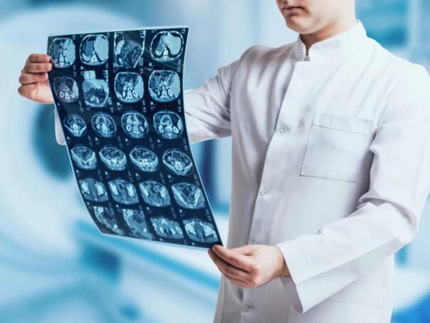 Nova terapija upola smanjuje agresivni rak mozga