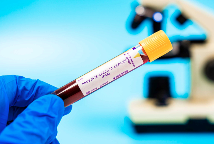 Novi AI alat skraćuje čekanje na dijagnozu raka prostate