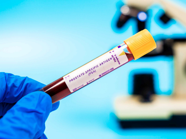 Novi AI alat skraćuje čekanje na dijagnozu raka prostate