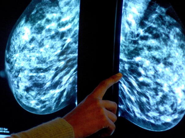 Novi lijek usporava napredovanje neizlječivog raka dojke