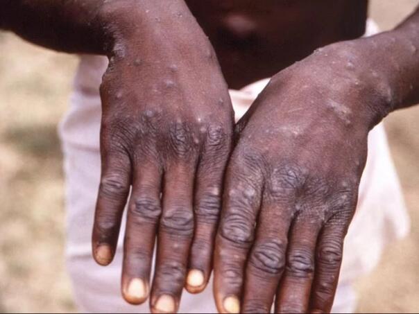 Novi smrtonosni oblik ubojitog virusa otkriven u Kongu