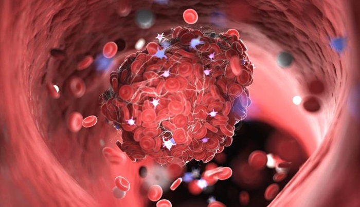 Obdukcijom žrtava COVID-19 pronađeni krvni ugrušci u skoro svakom organu