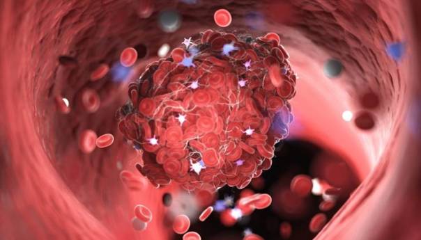 Obdukcijom žrtava COVID-19 pronađeni krvni ugrušci u skoro svakom organu