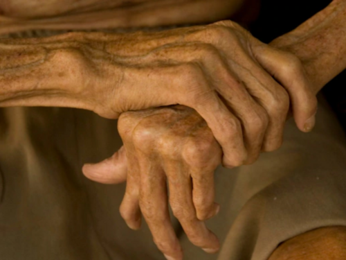 Objavljeno stanje stranog radnika zaraženog leprom u Hrvatskoj