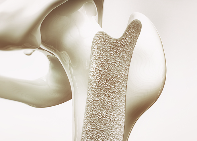 Osteoporoza više ne pogađa isključivo starije osobe, u riziku žene u periodu ulaska u menopauzu