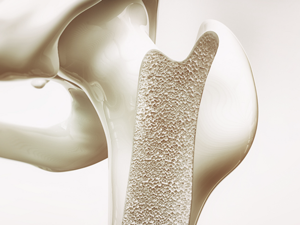 Osteoporoza više ne pogađa isključivo starije osobe, u riziku žene u periodu ulaska u menopauzu