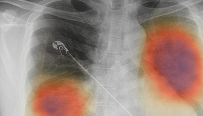 Otkrivena nova tehnika skeniranja pluća koja uočava inače nevidljiva oštećenja