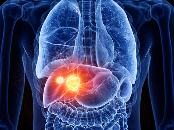 Ova vrsta karcinoma je među najučestalijim u Srbiji