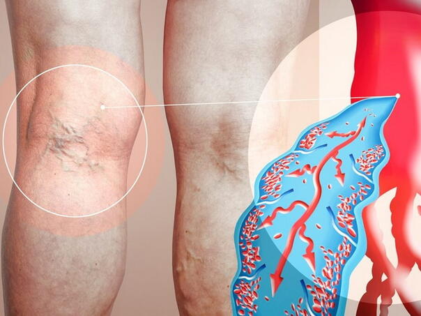 Ovi simptomi mogu biti znak da se u tijelu stvara tromb