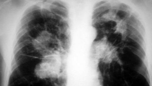 Paralija: U Federaciji BiH u 2021. godini od tuberkuloze oboljele 293 osobe