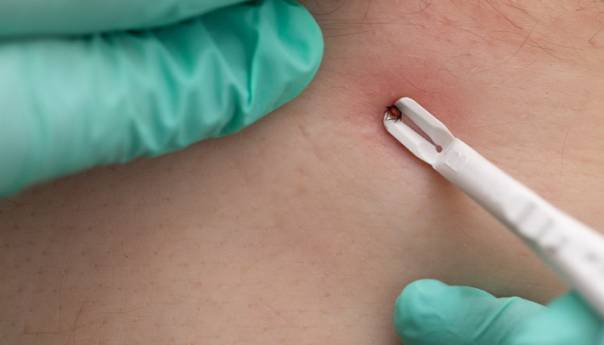 Počela je sezona krpelja: Evo kako se od njih možete zaštititi!