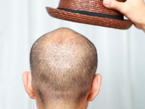 Popularni slatki napici utječu na gubitak kose kod muškaraca