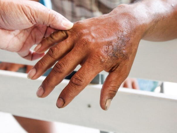 Potvrđen slučaj gube u Hrvatskoj kod stranog radnika