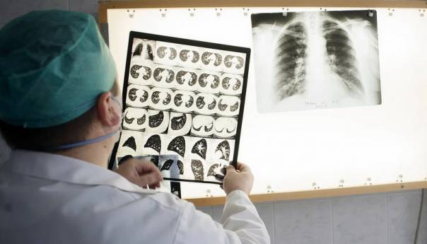 Povećan broj preminulih od tuberkuloze u posljednjim godinama