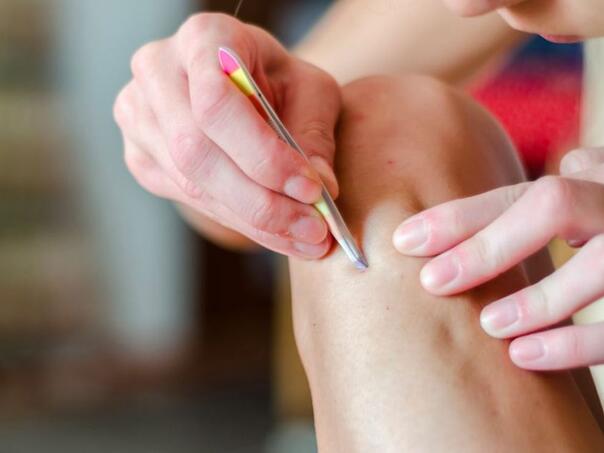 Praksa čupanja dlaka može izazvati velike probleme