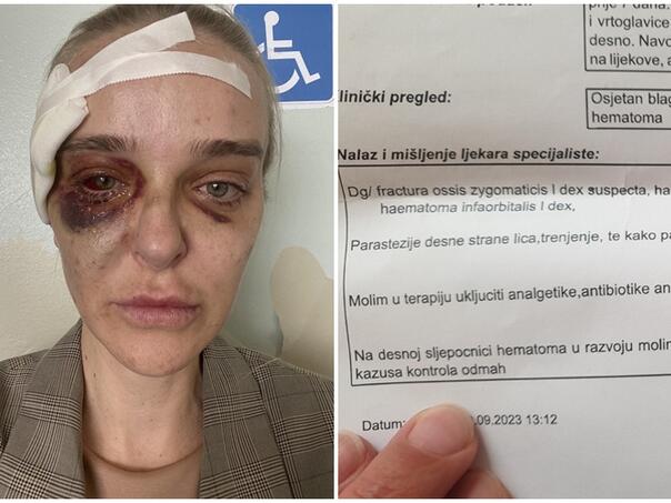 Pretučena doktorica za Vijesti: Čini mi se da sam sljedeća Nizama