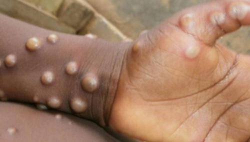 Prijavljeno skoro 200 slučajeva majmunskih boginja u više od 20 zemalja