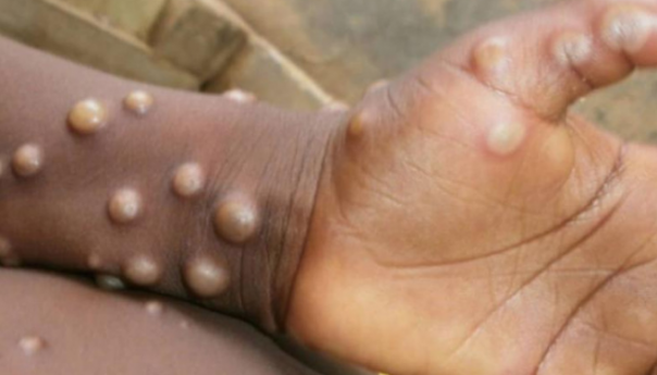 Prijavljeno skoro 200 slučajeva majmunskih boginja u više od 20 zemalja