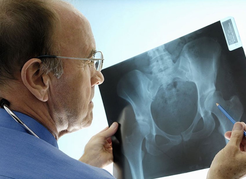 Prijeti nam epidemija osteoporoze, srčanog i moždanog udara