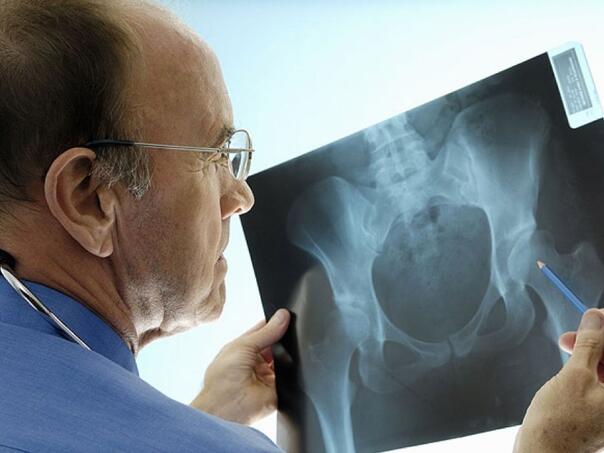 Prijeti nam epidemija osteoporoze, srčanog i moždanog udara