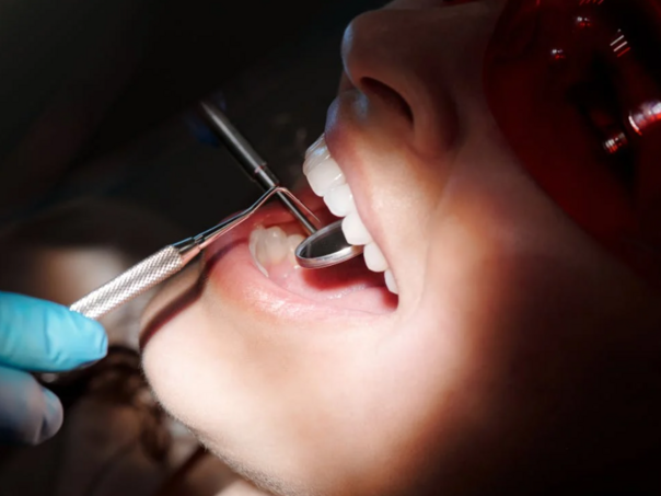 Promjene u ustima mogu biti upozorenje na holesterol