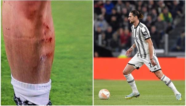 Rabiot pokazao kako mu izgleda noga nakon nedosuđenog penala