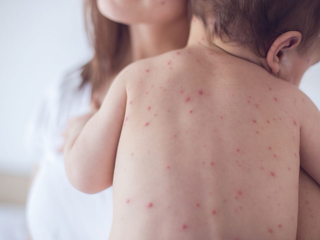 Raste broj oboljelih od morbila: Epidemija u Bijeljini