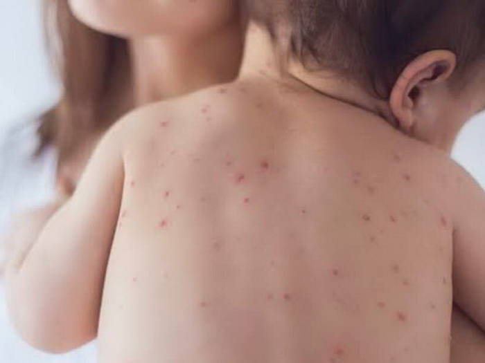 Raste broj zaražene djece morbilima u RS, u Bijeljini najviše oboljelih i sa upalama pluća