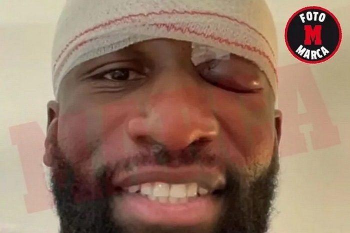 Rüdiger dobio 20 šavova: Upitan za El Clasico