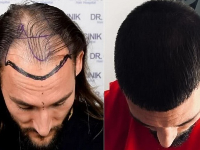 Reprezentativac Srbije presadio kosu u Turskoj, rezultati su nevjerovatni