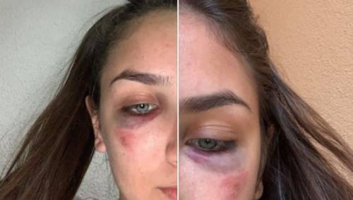 Reprezentativke BiH u karateu Ema i Ena Selman pretučene u svom stanu