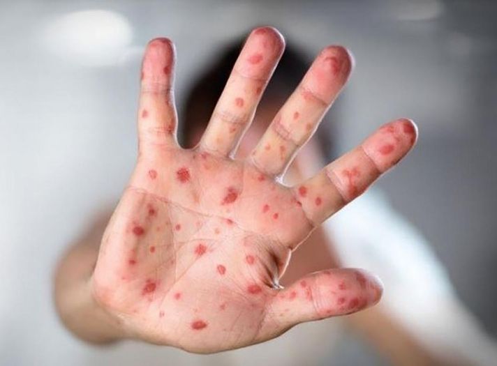 Samo 58 posto djece u Bosni i Hercegovini primilo prvu dozu vakcine protiv morbila