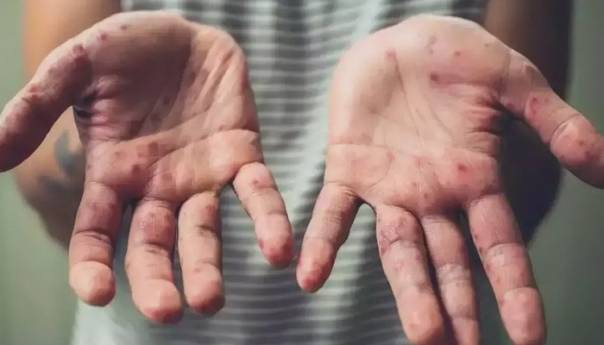 Sedmični broj slučajeva majmunskih boginja povećan za 20 posto