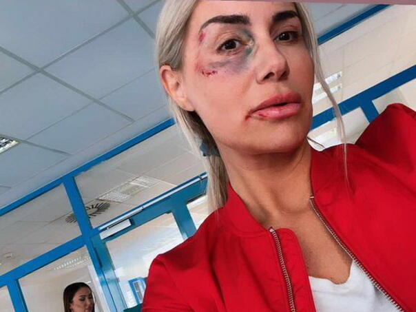 Selma Bajrami u modricama, "završila" u bolnici, stiglo objašnjenje