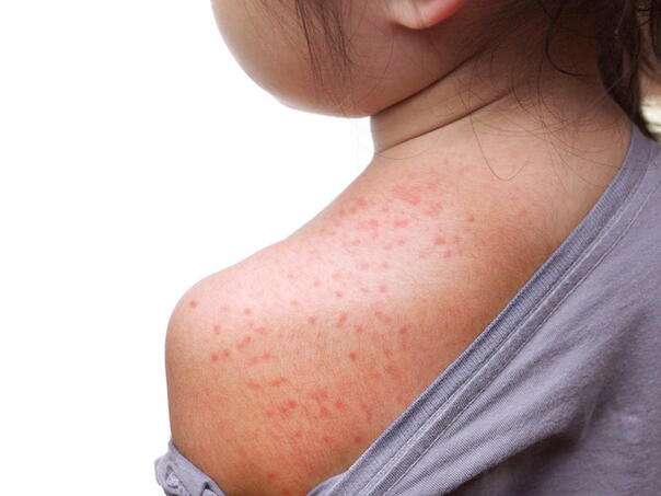 Šeranić: Kod desetero lica potvrđene morbile