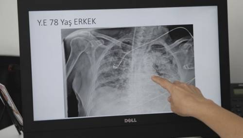 Snimci pokazuju štetu koju koronavirus izaziva na plućima