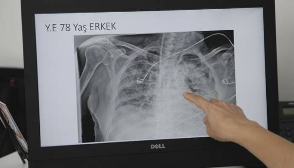 Snimci pokazuju štetu koju koronavirus izaziva na plućima