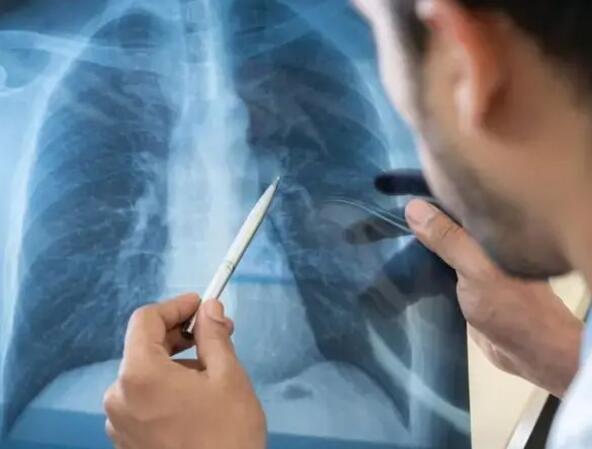 Šta je legionarska bolest koju izaziva bakterija legionela?