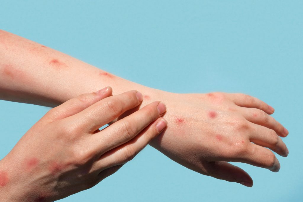 Šta je virus chikungunya koji se širi svijetom i izaziva zabrinutost