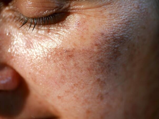 Staračke pjege nestaju u četiri sedmice: Dermatolozi otkrivaju kako!